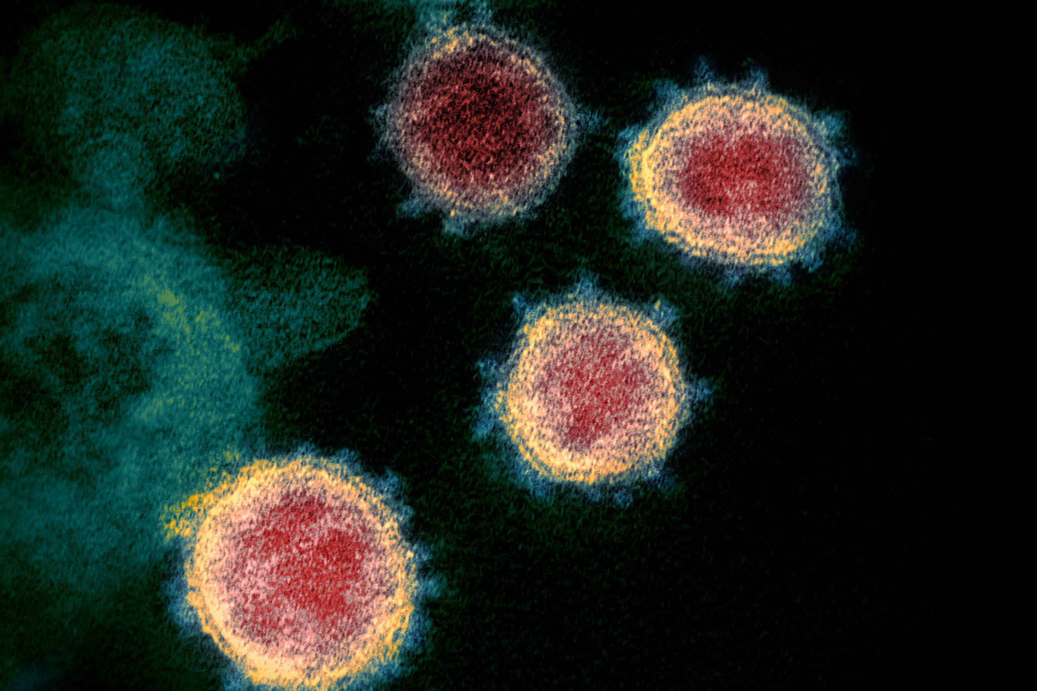 FILE – This undated electron microscope image made available by the U.S. National Institutes of Health in February 2020 shows the virus that causes COVID-19. (NIAID-RML via AP, File)