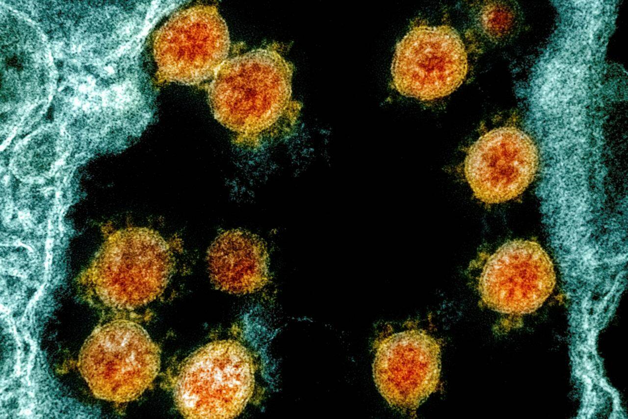 This electron microscope image made available and color-enhanced by the National Institute of Allergy and Infectious Diseases Integrated Research Facility in Fort Detrick, Md., shows Novel Coronavirus SARS-CoV-2 virus particles, orange, isolated from a patient. Putting an end to the COVID-19 pandemic will mean priming the immune systems of everyone on Earth but the virus is mutating and could take years to “settle down,” says an expert. THE CANADIAN PRESS/AP-NIAID/National Institutes of Health