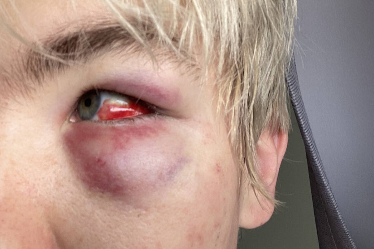 Spencer Frey suffered multiple facial injuries in an assault at a house party this past weekend and Nanaimo RCMP are investigating the incident as a possible hate crime. (Photo courtesy Spencer Frey)