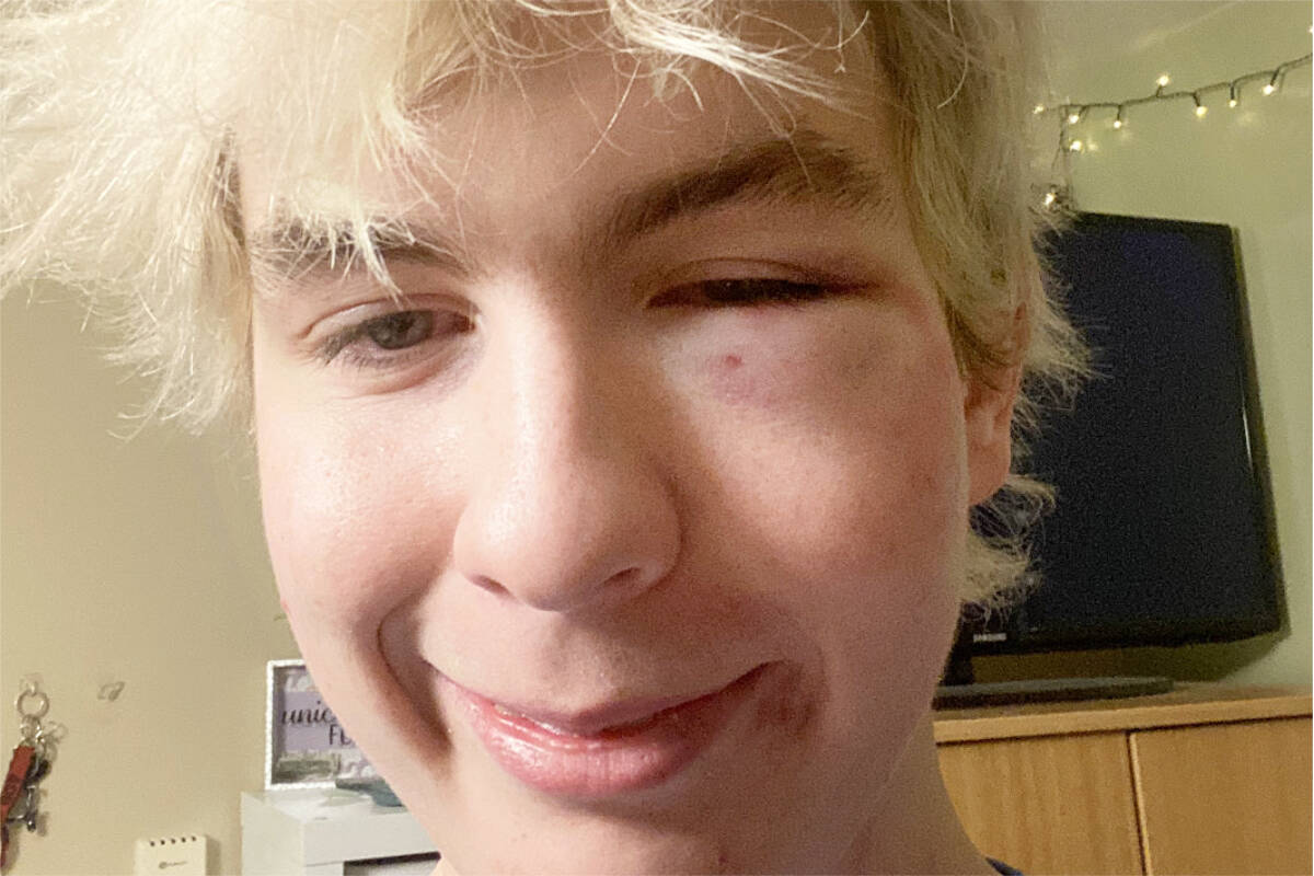 Spencer Frey suffered multiple facial injuries in an assault at a house party this past weekend and Nanaimo RCMP are investigating the incident as a possible hate crime. (Photo courtesy Spencer Frey)