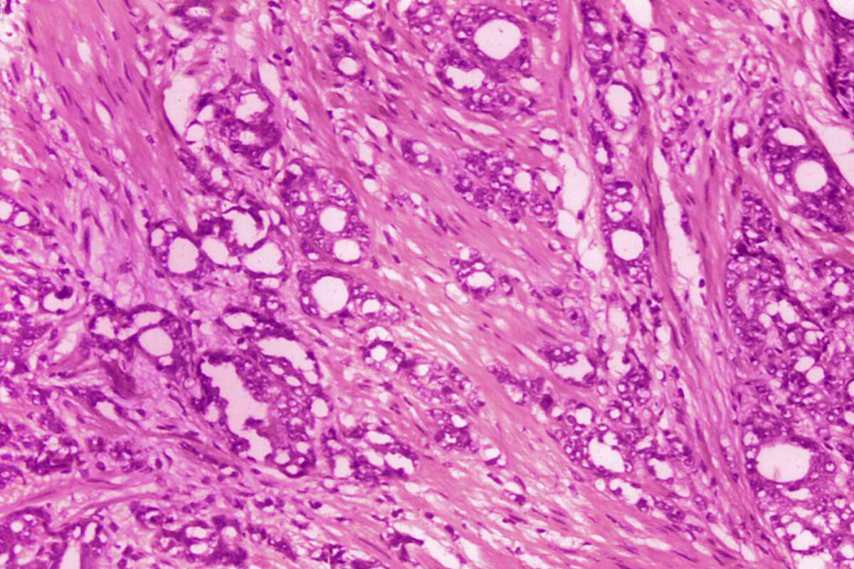 This 1974 microscope image made available by the Centers for Disease Control and Prevention shows changes in cells indicative of adenocarcinoma of the prostate. Some doctors say it’s time to rename low-grade prostate cancer to eliminate the alarming C word. About 34,000 Americans die from prostate cancer annually, but most prostate cancers are harmless. A paper published Monday, April 18, 2022 in the Journal of Clinical Oncology is reviving a debate about dropping the word “cancer” when patients learn the results of these low-risk biopsy findings. (Dr. Edwin P. Ewing, Jr./CDC via AP)