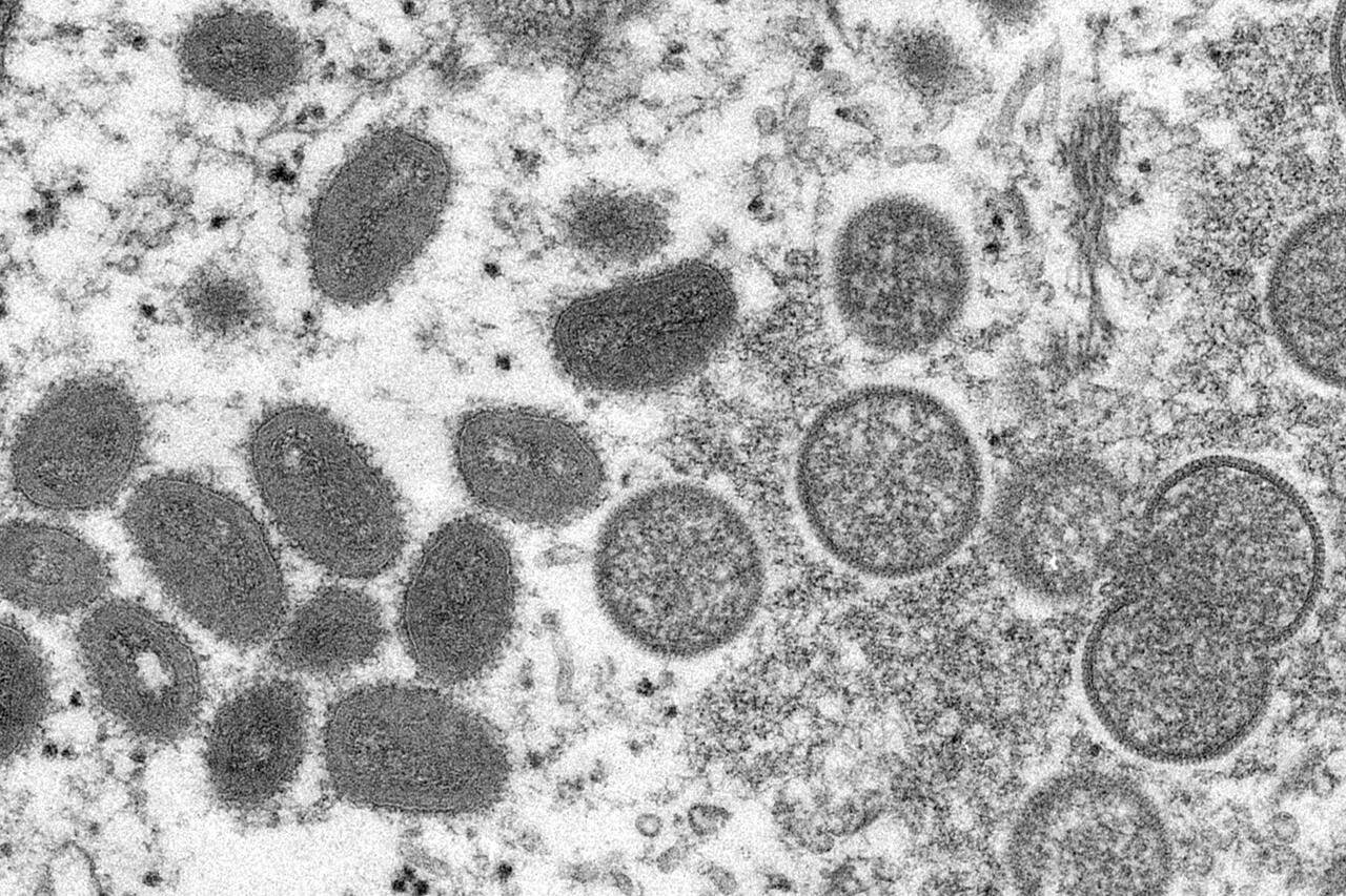 This 2003 electron microscope image made available by the Centers for Disease Control and Prevention shows mature, oval-shaped monkeypox virions, left, and spherical immature virions, right, obtained from a sample of human skin associated with the 2003 prairie dog outbreak. On Wednesday, May 18, 2022, Portuguese health authorities confirmed five cases of monkeypox in young men, marking an unusual outbreak in Europe of a disease typically limited to Africa. (Cynthia S. Goldsmith, Russell Regner/CDC via AP)