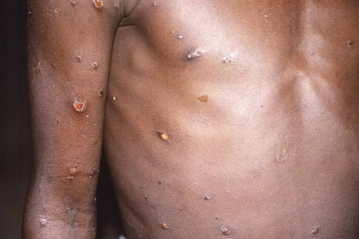 FILE - This 1997 image provided by U.S. Centers for Disease Control and Prevention shows the right arm and torso of a patient, whose skin displayed a number of lesions due to what had been an active case of monkeypox. As health authorities in Europe and elsewhere roll out vaccines and drugs to stamp out the biggest monkeypox outbreak beyond Africa, in 2022, some doctors are acknowledging an ugly reality: The resources to slow the disease’s spread have long been available, just not to the Africans who have dealt with it for decades. (CDC via AP, File)