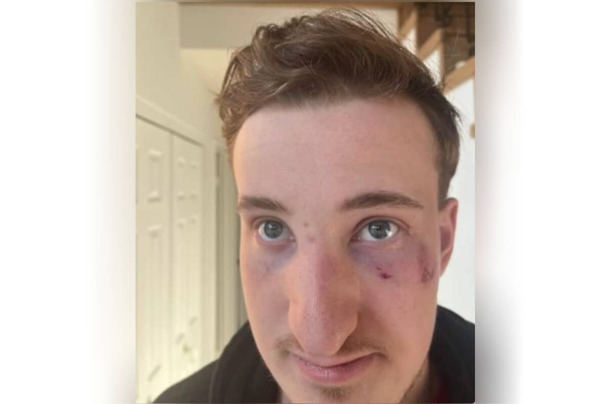 Ashton Pede went to the Vernon hospital Friday night, Sept. 30, after allegedly being attacked by a bus driver during a B.C. Hockey League game. (Contributed)