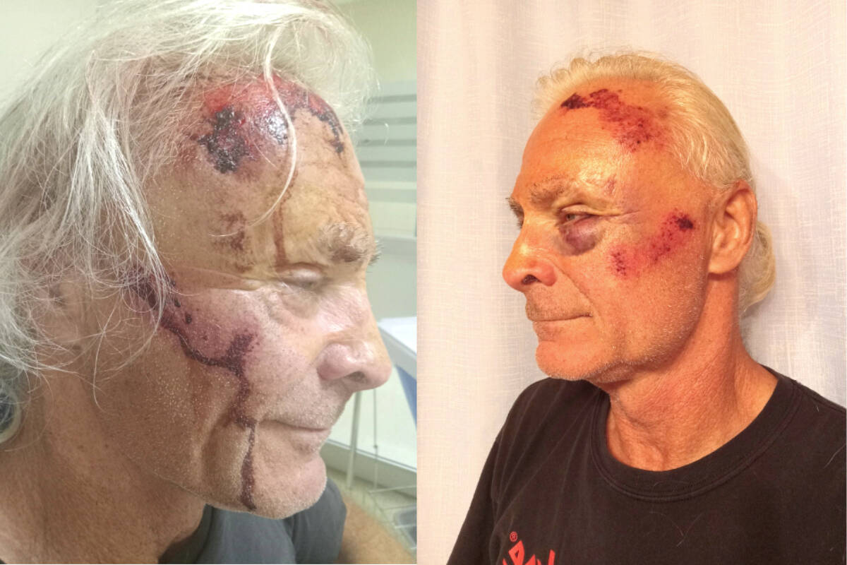 Korry Zepik said his head was pushed into the pavement while he was protesting against the anti-COVID crowd Oct. 1 in Vernon. (Contributed)