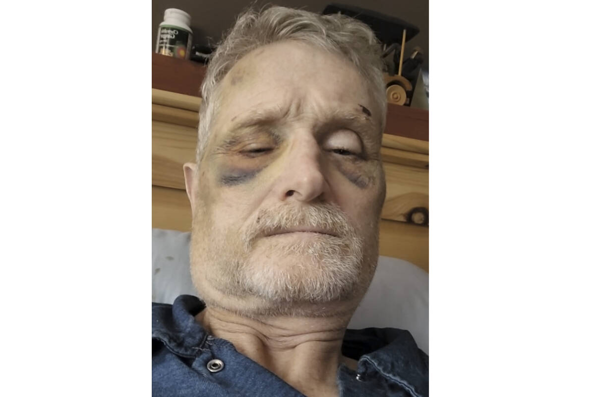 Ron Bendle posted this image of his face in a Facebook post on Nov. 7, and alleged he was assaulted by a Nelson police officer. Photo: Facebook
