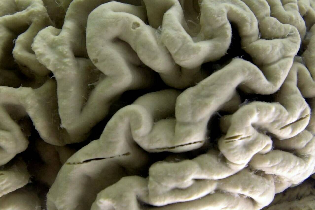 FILE - This Oct. 7, 2003 file photo shows a closeup of a human brain affected by Alzheimer’s disease, on display at the Museum of Neuroanatomy at the University at Buffalo in Buffalo, N.Y. An experimental Alzheimer’s drug modestly slowed the brain disease’s inevitable worsening, researchers reported Tuesday, Nov. 29, 2022 - and the next question is how much difference that might make in people’s lives. Japanese drugmaker Eisai and its U.S. partner Biogen had announced earlier this fall that the drug lecanemab appeared to work, a badly needed bright spot after repeated disappointments in the quest for better Alzheimer’s treatments. (AP Photo/David Duprey)