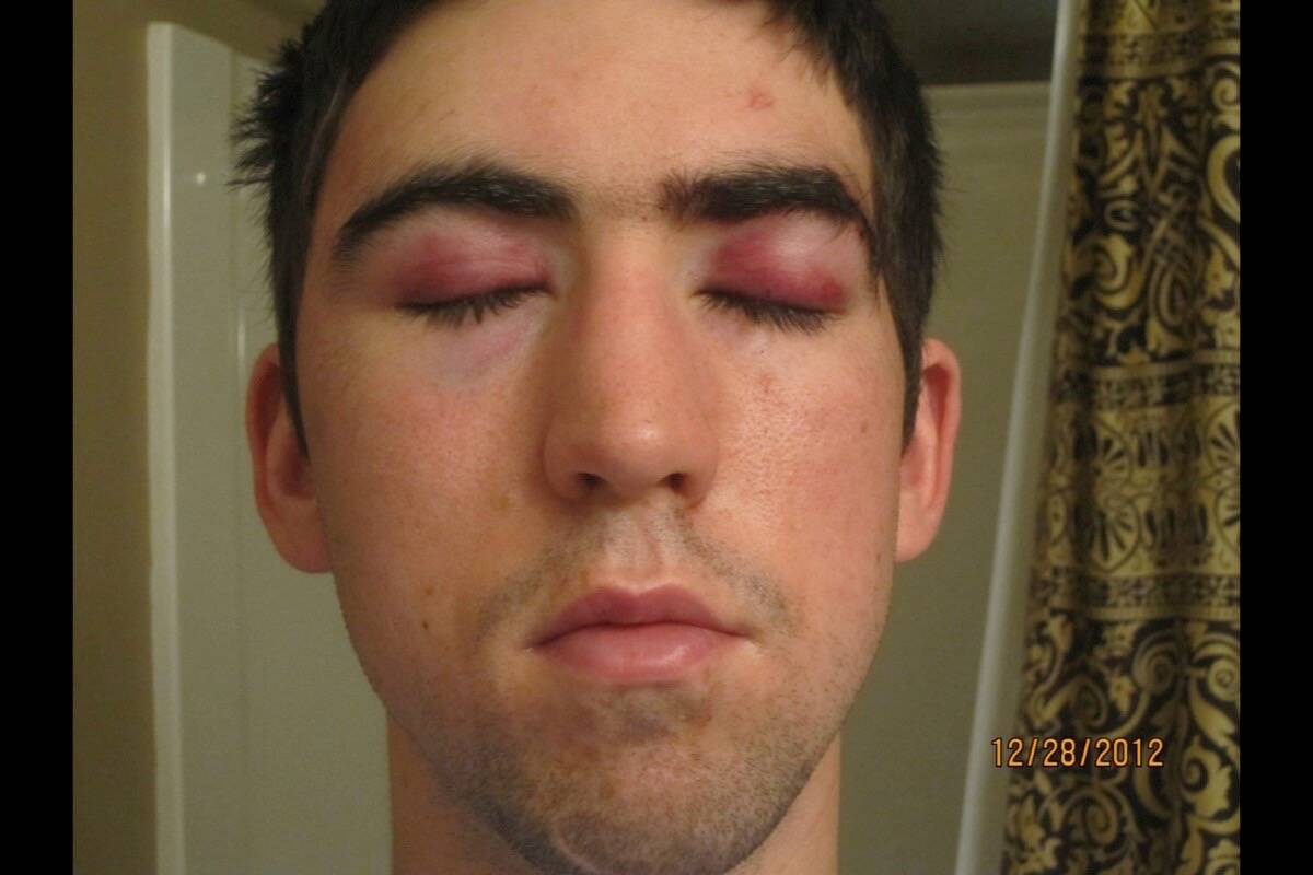 Pictured is Kyle Mockford shortly after he was assaulted in 2012. (Submitted photo)