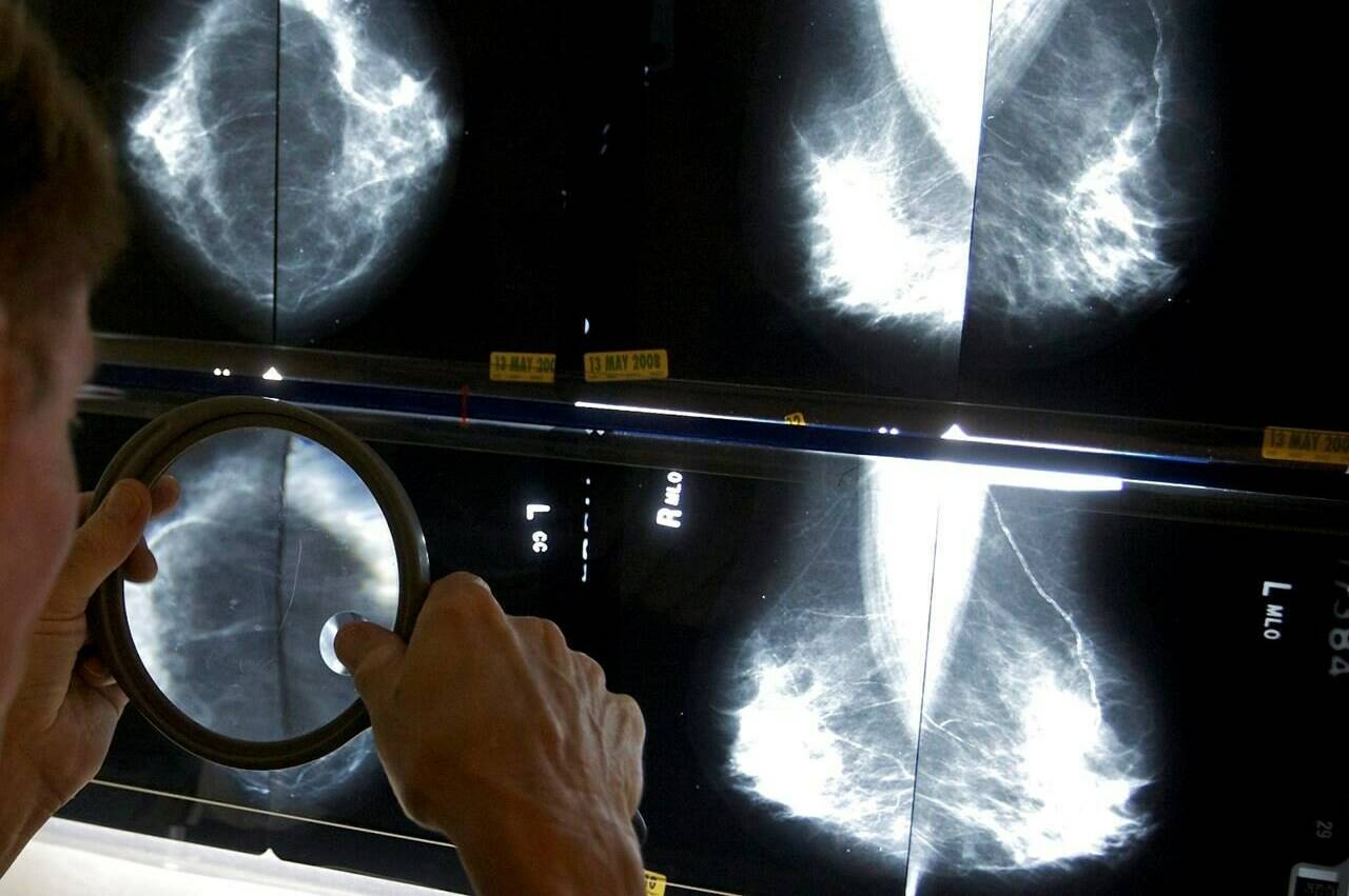 In this May 6, 2010 file photo, a radiologist uses a magnifying glass to check mammograms for breast cancer in Los Angeles. (Damian Dovarganes/THE CANADIAN PRESS/AP)