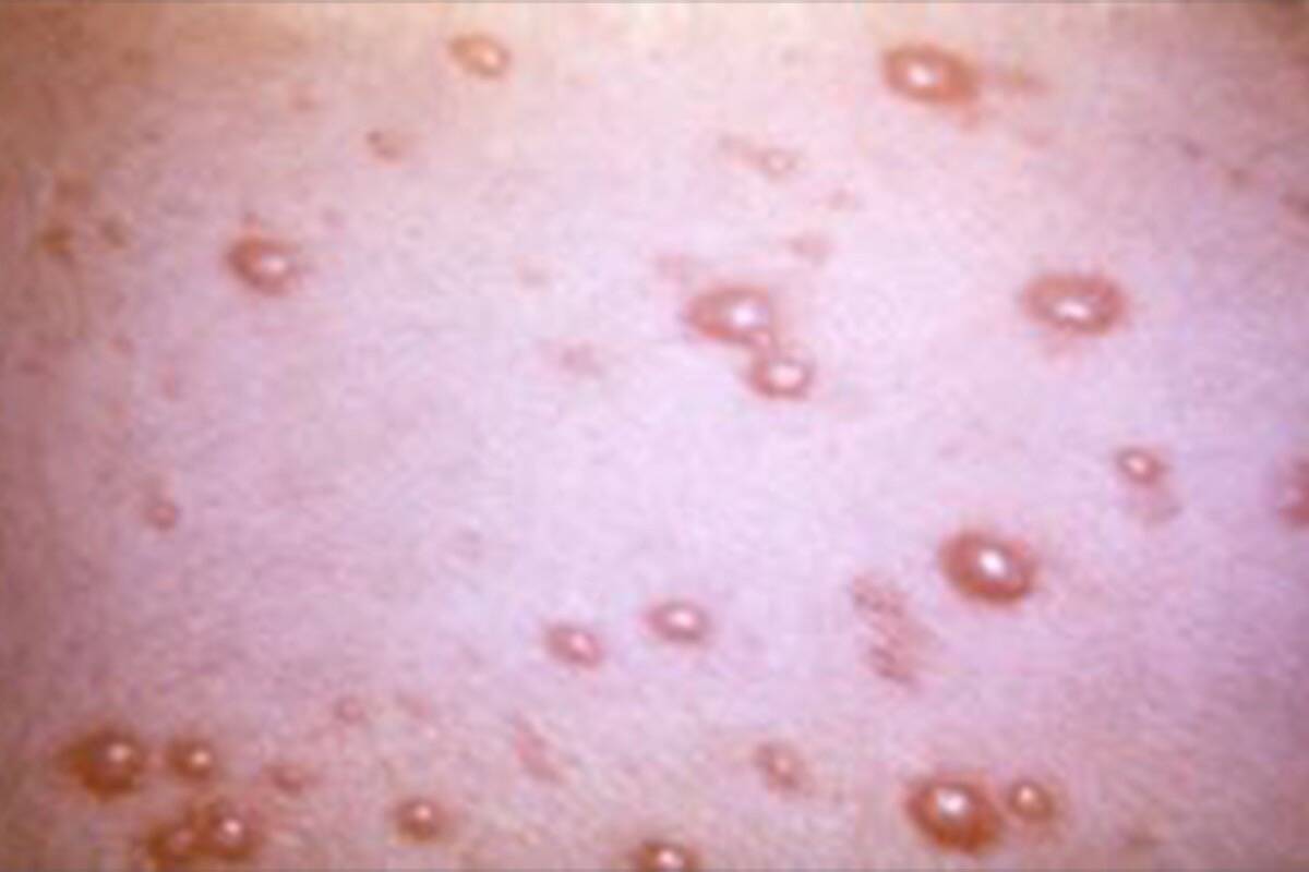 A shingles rash. (Image: BC Centre for Disease Control)