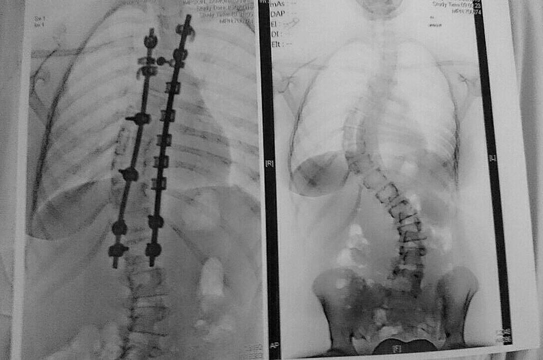 A before, right, and after, left, x-ray of scoliosis. Contributed photo