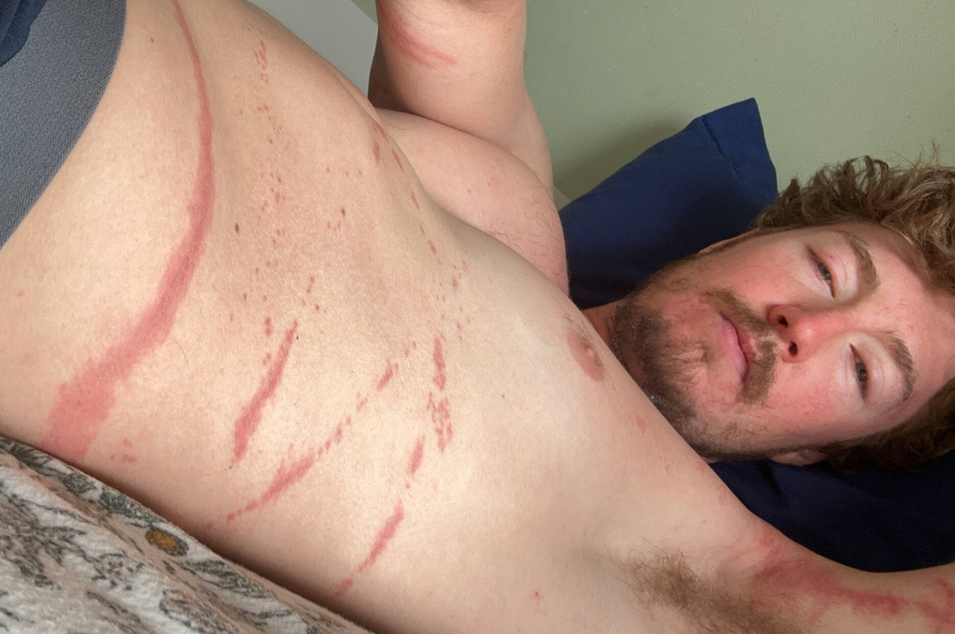 Kelowna ultra-endurance athlete Nick Pelletier shows off his injuries left by the jellyfish in this selfie image. The British Columbia man’s quest to swim through shark-invested waters of a Hawaiian channel was scuttled by jellyfish. THE CANADIAN PRESS/HO-Nick Pelletier