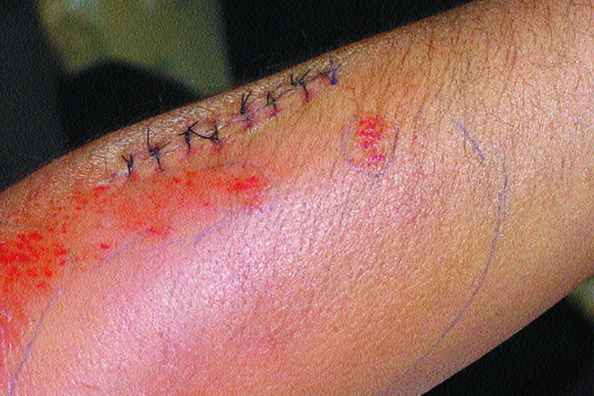 Some of the stitches Philip Wolf picked up during a bout with flesh-eating disease in 2002. (Heather Prestage photo)