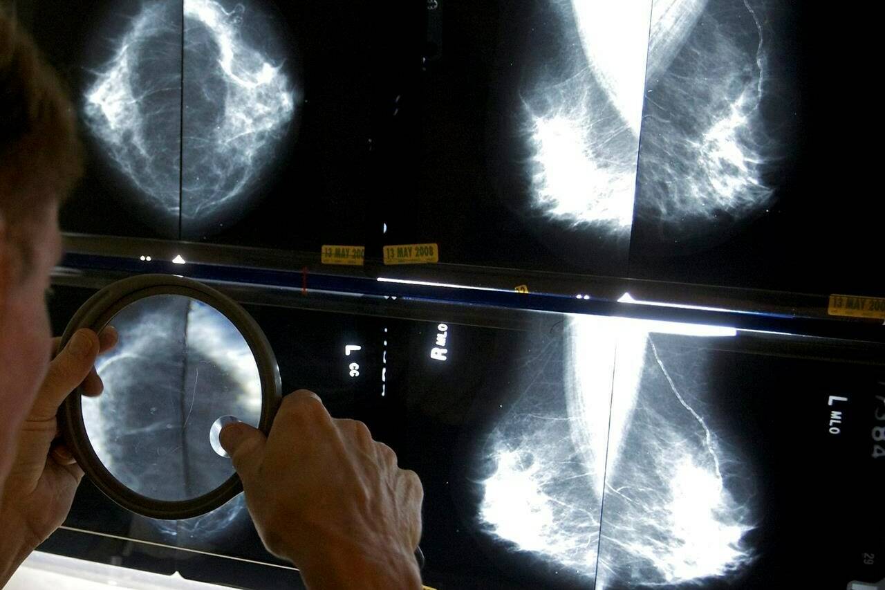 In this May 6, 2010 file photo, a radiologist uses a magnifying glass to check mammograms for breast cancer in Los Angeles. The Canadian Cancer Society says all provinces and territories should lower the starting age for breast cancer screening to 40. THE CANADIAN PRESS/AP-Damian Dovarganes